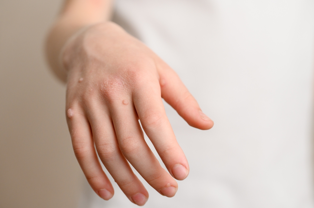 warzen an der hand